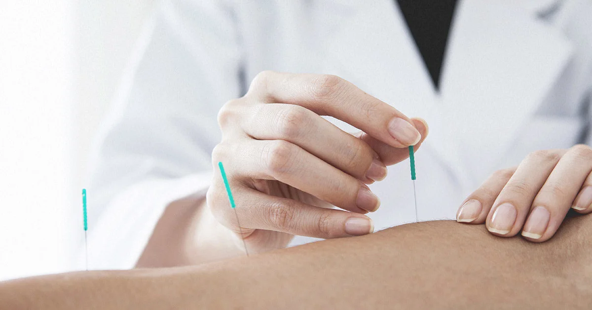 Dry Needling for C-Section Scars and Postpartum Recovery