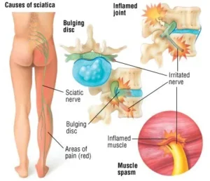 Cause of Sciatica