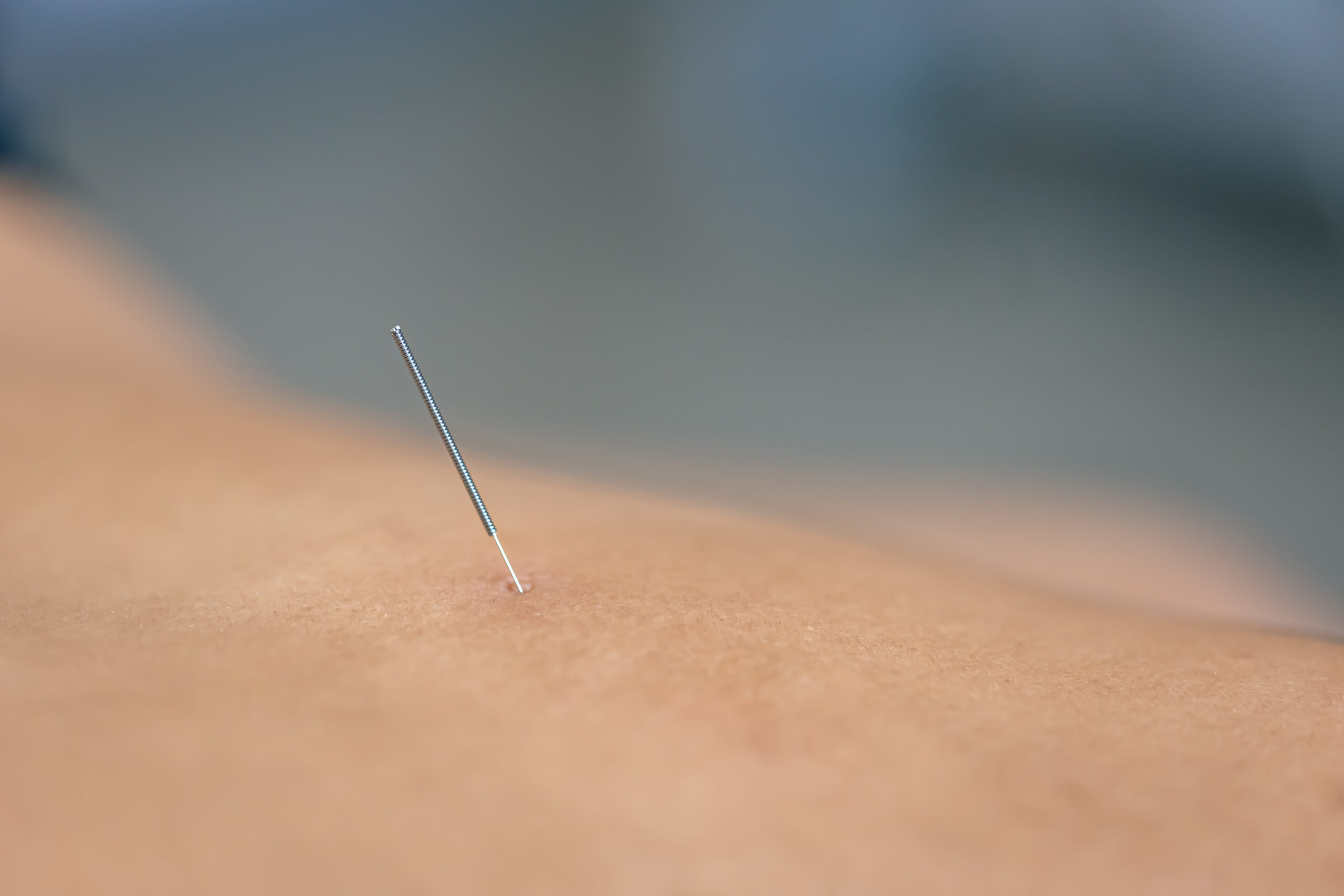 Dry Needling: Physical Therapy Modalities
