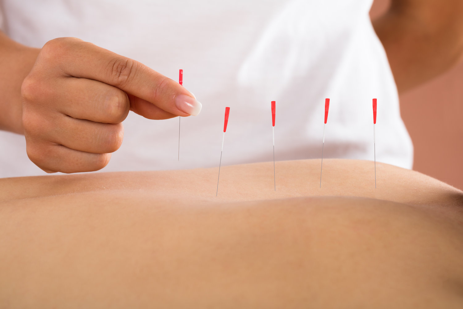 Dry Needling and the Pelvic Floor