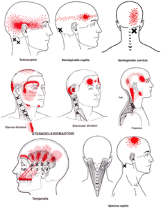 Headaches with Fascial Counterstrain